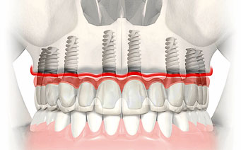Dantų protezų ant implantų tvirtinimas<br /><br />