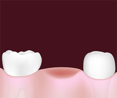 Dantų protezai su implantais ar be jų?