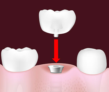Dantų protezai su implantais ar be jų?